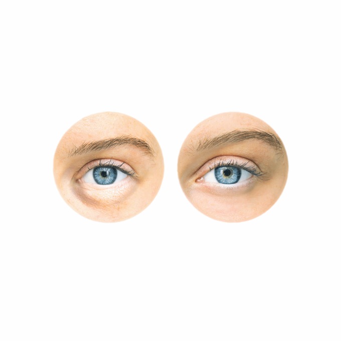 Puffy Eye Relief, , large
