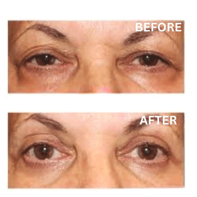 Upper Eyelid Lifter Cream, , large