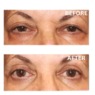 Upper Eyelid Lifter Cream, , large